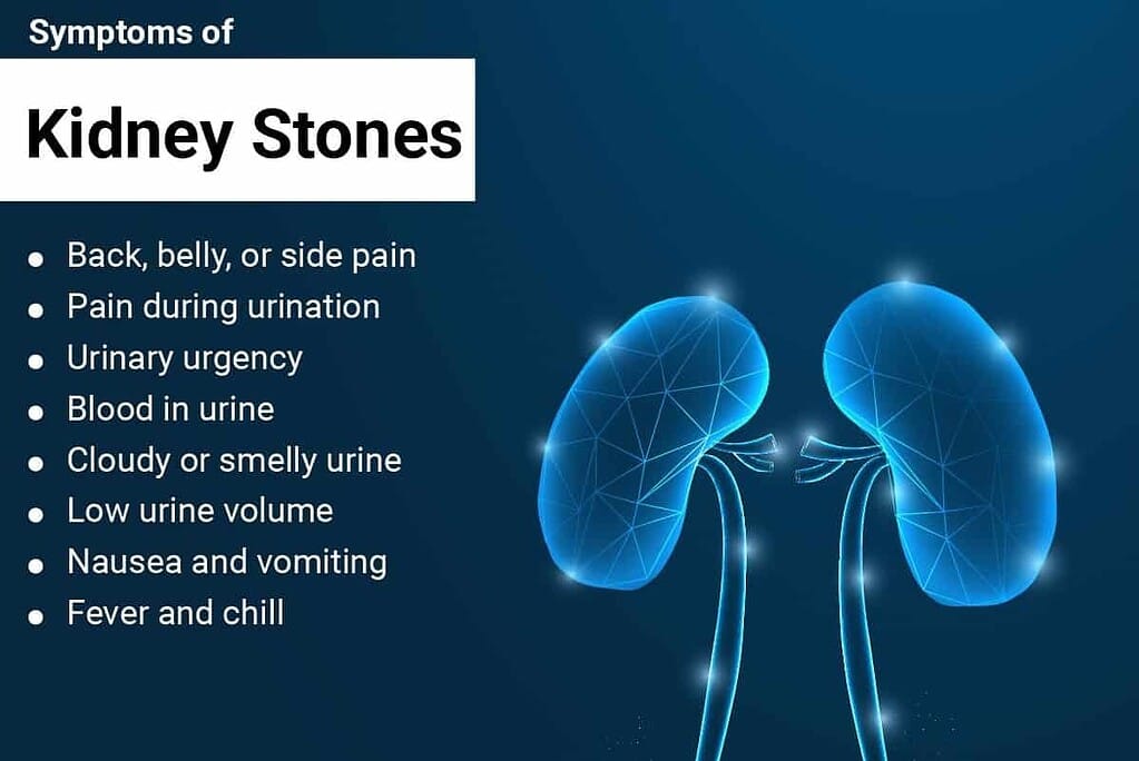 Kidney Stones