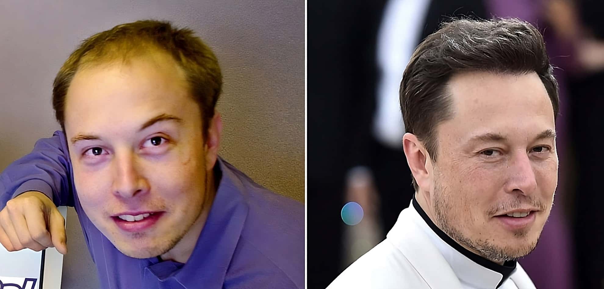 Hair Transplant Elon_Musk-transformed