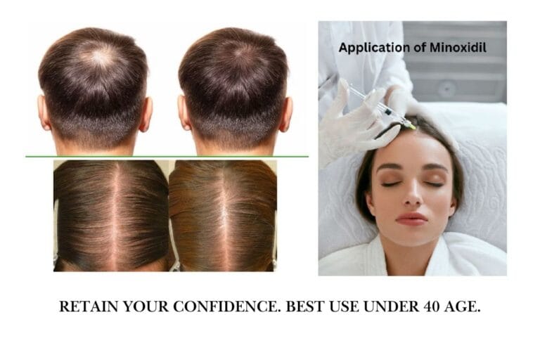 Benefits of Monoxidil